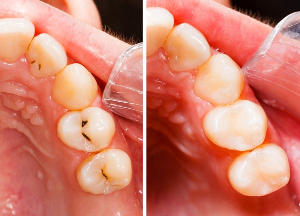 Konservierende Zahnheilkunde von Dr. Stephanie Flaig, Zahnärztin München